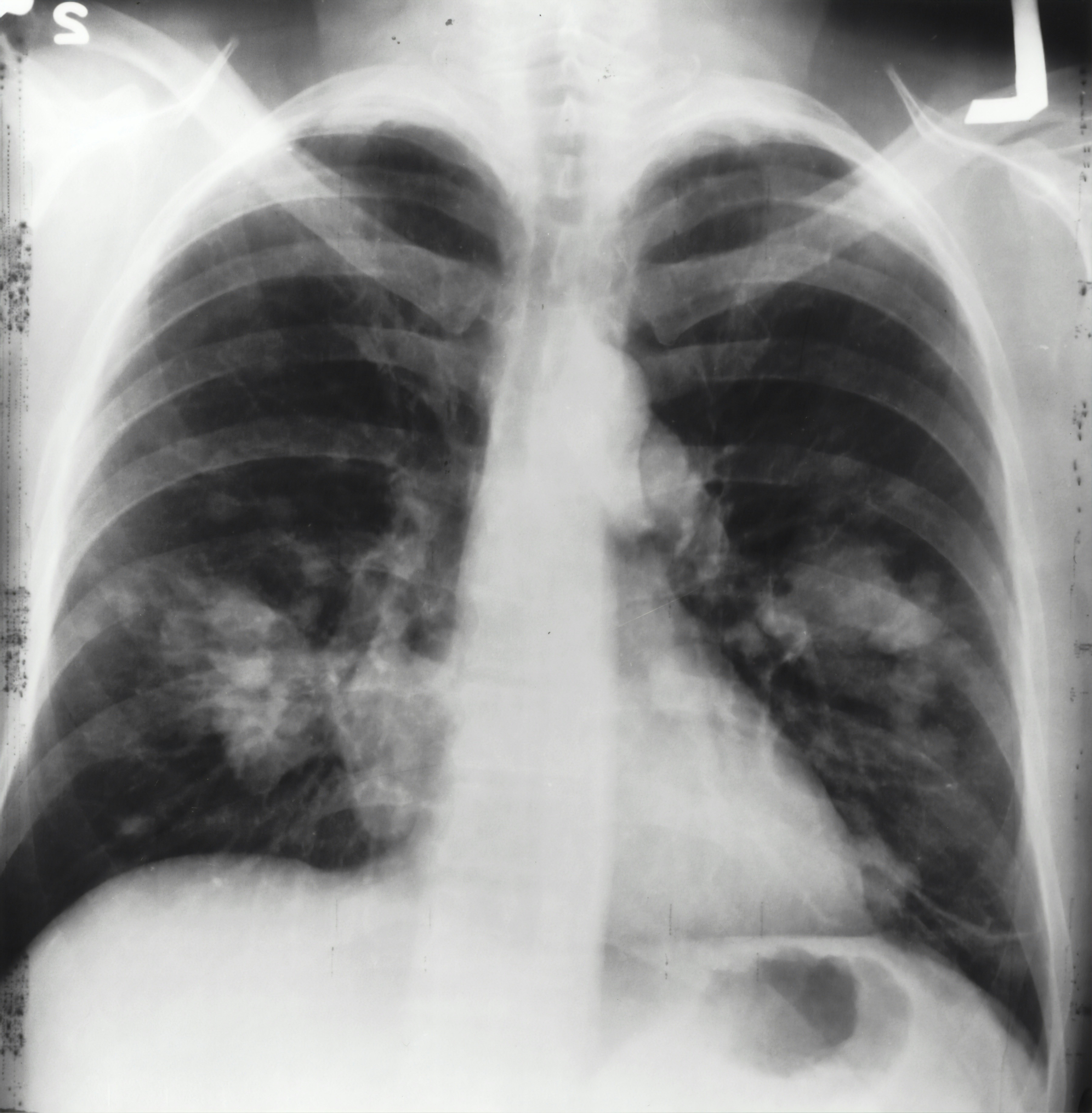 A chest x-ray like the ones Danny Collinson worked on in this project